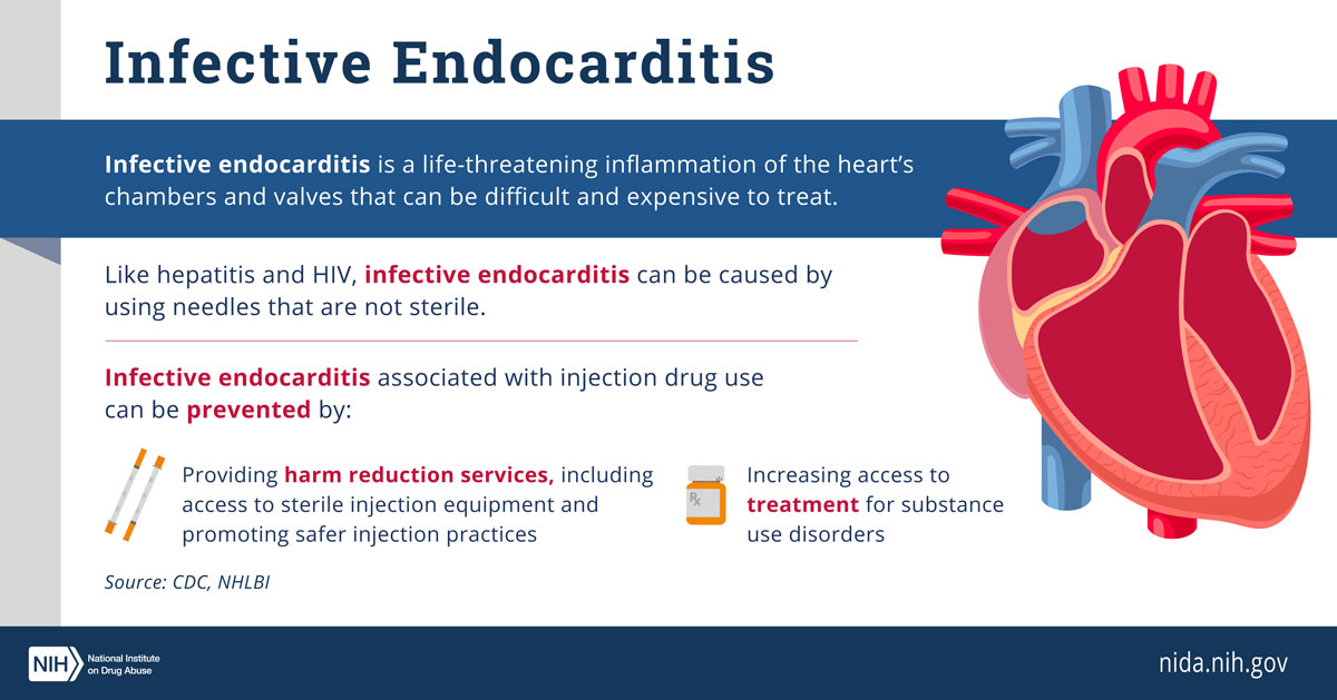 Infective Endocarditis | National Institute on Drug Abuse (NIDA)