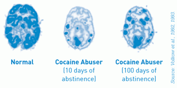 PET scan showing three scans, a normal brain, a brain of a cocaine abuser with 10 days abstinence, and a brain of a cocaine abuser with 100 days abstinence. 
