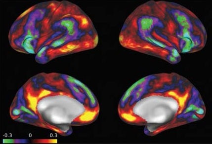 This shows 4 pictures of brain scans from different angles, shaded in red, yellow, blue, purple, and green.