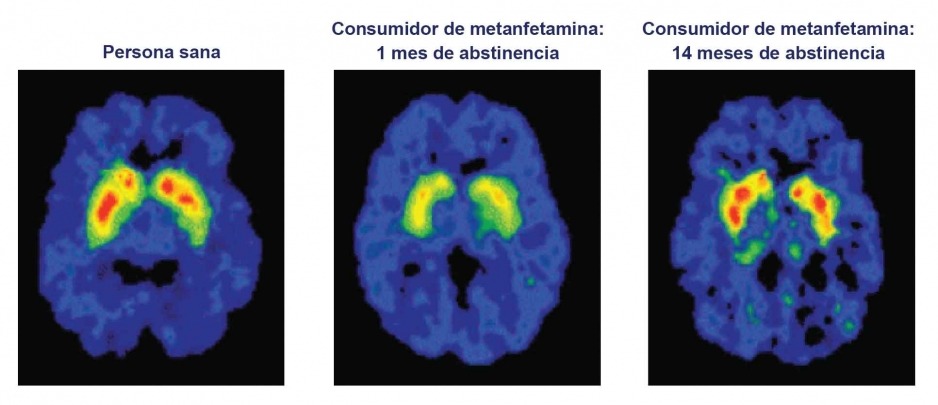 El consumo indebido de metanfetamina reduce en gran medida la adhesión de la dopamina a sus transportadores (resaltados en rojo y verde) en el estrato, un área cerebral importante para la memoria y el movimiento. Con abstinencia prolongada, los transportadores de dopamina en esta área se pueden restaurar.