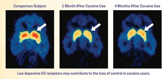 Brain scans that show changes in the brain after 1 and 4 months of cocaine use vs. in someone who has never used cocaine.