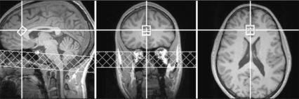 Measuring glutamate in the brain’s dorsal anterior cingulate cortex, an area important for emotion, cognition and behavior