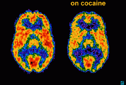 Positron emission tomography (PET) scan of a person on cocaine