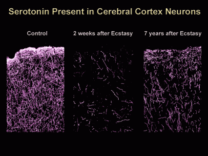 image of cerebral cortex neurons showing the loss of serotonin-containing nerve endings in monkeys folliowing 2 weeks (about 95% reduction) and 7 years (about 50% reduction) following MDMA exposure