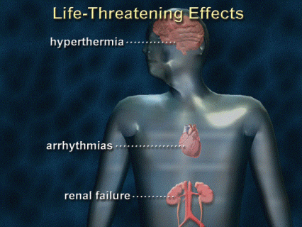 Illustration of human body showing hyperthermia, arrythmias and renal failure as life threatening effects of MDMA