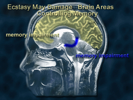 Illustration showing memory impairment in brain regions - see text