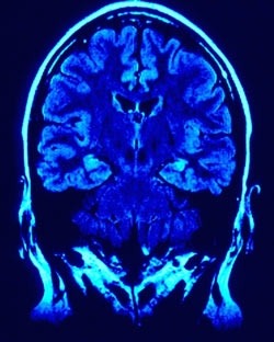 Imagen del cerebro obtenida por resonancia magnética