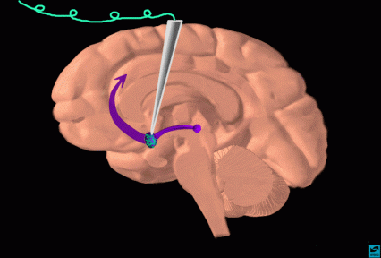 Injection of cocaine into the nucleus accumbens
