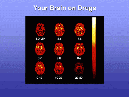 This is literally the brain on drugs - see text