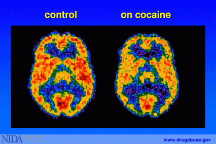 PET scan of a person using cocaine