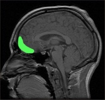The orbitofrontal cortex, as shown by human brain imaging.