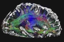 Imágenes del cerebro que muestran diagramas detallados de los tractos neuronales