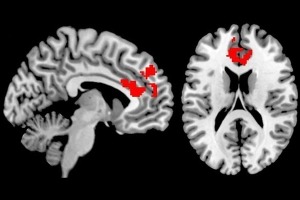 Una sección transversal longitudinal (izquierda) y una sección transversal horizontal (derecha) de un cerebro. Las áreas rojas indican las áreas de la corteza prefrontal medial que se utilizaron para evaluar la conectividad funcional.