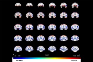 Structural MRI scans of Rhesus Monkey brains at baseline and after 1 year of cocaine self-administration in rhesus monkeys. Blue indicates areas where GMD decreased compared with baseline; red indicates areas of GMD increase