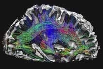 Brain image showing detailed diagrams of neural tracts